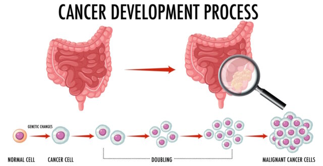 Diagram showing cancer development process https://www.freepik.com/free-vector/diagram-showing-cancer-development-process_25538781.htm#query=colon%20cancer&position=20&from_view=search&track=ais