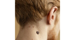 https://www.freepik.com/free-photo/close-up-young-man-with-mole-neck_25128919.htm#query=melanoma&position=22&from_view=search&track=sph