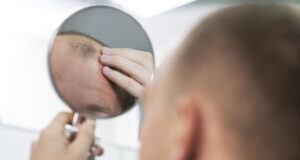 https://www.freepik.com/free-photo/adult-male-having-balding-problems_19966395.htm#query=bald%20hair%20man&position=38&from_view=search&track=ais
