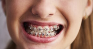 https://www.freepik.com/free-photo/shot-teeth-with-braces_15971638.htm#query=dential%20braces&position=10&from_view=search&track=ais