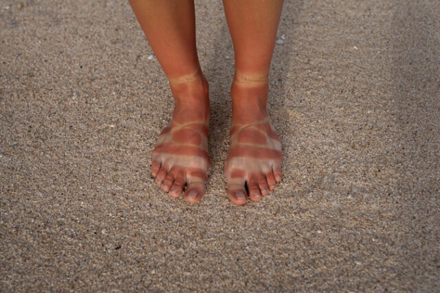 https://www.freepik.com/free-photo/view-woman-s-sunburn-feet-from-wearing-sandals-beach_40165584.htm#page=2&query=sunburn&position=5&from_view=search&track=sph