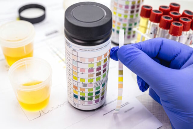https://www.freepik.com/premium-photo/urine-test-made-with-vial-urinalysis-reagent-strip-used-ketosis-control-laboratory-examination_25310022.htm#&position=39&from_view=search&track=ais&uuid=c757ce8d-da65-4761-ac3d-1990232db686