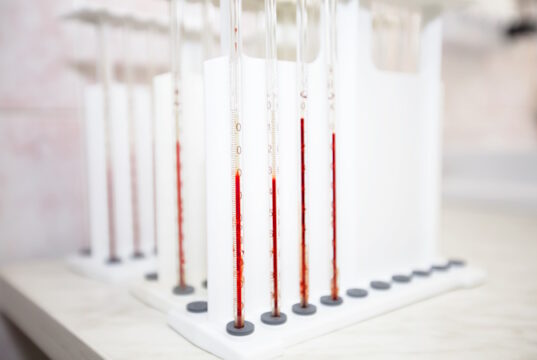 https://www.vecteezy.com/photo/28584988-test-tubes-with-blood-in-a-medical-biochemical-laboratory