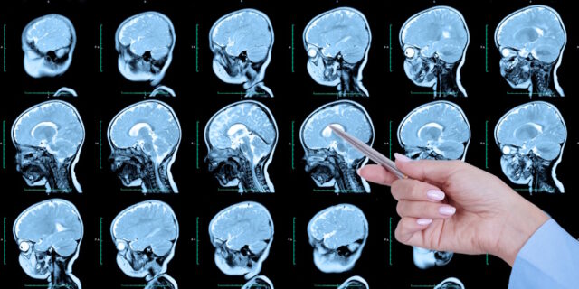 Doctor's hand points to a set of MRI scans of the human skull and brain, with cerebral malformations, preliminary diagnosis, holoproencephaly, absence, agenesis of the transparent septum, side view. https://www.vecteezy.com/photo/8136335-doctor-s-hand-points-to-a-set-of-mri-scans-of-the-human-skull-and-brain-with-cerebral-malformations-preliminary-diagnosis-holoproencephaly-absence-agenesis-of-the-transparent-septum-side-view