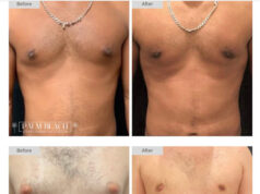 https://palmbeachgynecomastia.com/before-after-results/