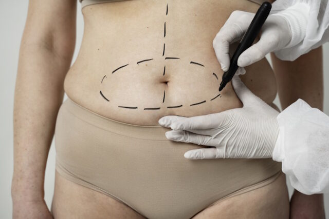 https://www.freepik.com/free-photo/front-view-woman-with-marker-traces-belly_25106475.htm#fromView=search&page=1&position=45&uuid=cee06e90-a891-4525-8127-71b72c26a0f0&query=tummy+tuck