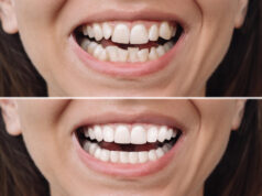 https://www.freepik.com/premium-photo/woman-before-after-veneers-installation-correction-uneven-teeth-with-braces_63532135.htm#fromView=search&page=1&position=17&uuid=53ad7b15-40d9-43ff-a090-389cd6c946db&query=veneers