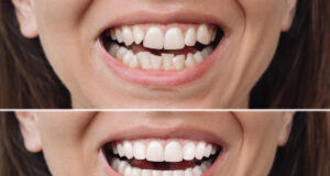 https://www.freepik.com/premium-photo/woman-before-after-veneers-installation-correction-uneven-teeth-with-braces_63532135.htm#fromView=search&page=1&position=17&uuid=53ad7b15-40d9-43ff-a090-389cd6c946db&query=veneers