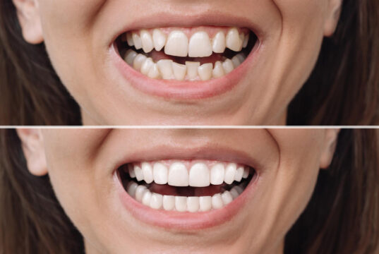 https://www.freepik.com/premium-photo/woman-before-after-veneers-installation-correction-uneven-teeth-with-braces_63532135.htm#fromView=search&page=1&position=17&uuid=53ad7b15-40d9-43ff-a090-389cd6c946db&query=veneers