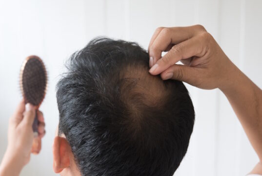 https://www.freepik.com/premium-photo/men-are-worried-about-hair-loss_2943650.htm#fromView=search&page=1&position=10&uuid=51b161c0-45ab-464b-adcc-ab4094d42adb&query=hairloss