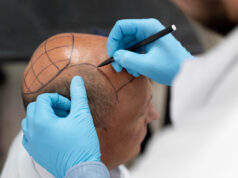 https://www.freepik.com/free-photo/male-going-through-follicular-unit-extraction-process_18737182.htm#fromView=search&page=1&position=4&uuid=c9ef030d-fc6e-4090-a7e4-a677e4378005&query=african+american+hair+transplant