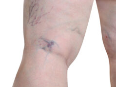 https://www.vecteezy.com/photo/12599291-woman-exposing-leg-with-varicose-veins-on-leg-capillary-varicose-veins-show-isolated-on-a-white-background