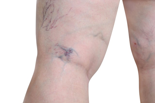 https://www.vecteezy.com/photo/12599291-woman-exposing-leg-with-varicose-veins-on-leg-capillary-varicose-veins-show-isolated-on-a-white-background