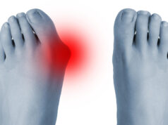 https://www.freepik.com/premium-photo/feet-before-after-surgical-correction-hallux-valgus_29096815.htm#fromView=search&page=1&position=23&uuid=0914c141-ac84-4676-b9d0-2fdea86d17f6&query=bunion
