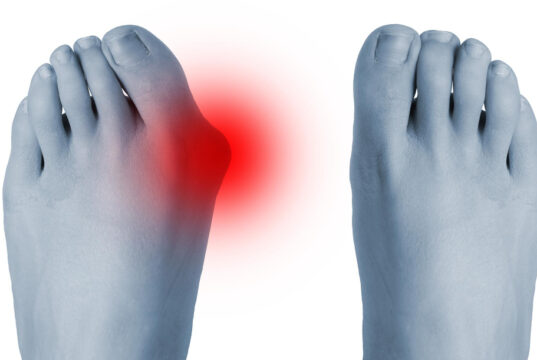 https://www.freepik.com/premium-photo/feet-before-after-surgical-correction-hallux-valgus_29096815.htm#fromView=search&page=1&position=23&uuid=0914c141-ac84-4676-b9d0-2fdea86d17f6&query=bunion