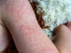https://www.vecteezy.com/photo/45633966-viral-disease-measles-rash-on-the-body-of-the-child-allergy
