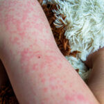 Viral disease. Measles rash on the body of the child. Allergy