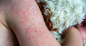 https://www.vecteezy.com/photo/45633966-viral-disease-measles-rash-on-the-body-of-the-child-allergy