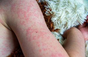 https://www.vecteezy.com/photo/45633966-viral-disease-measles-rash-on-the-body-of-the-child-allergy
