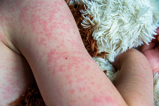 Viral disease. Measles rash on the body of the child. Allergy https://www.vecteezy.com/photo/45633966-viral-disease-measles-rash-on-the-body-of-the-child-allergy