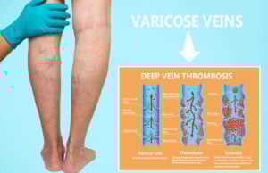 The Sweetener Shadow: Why Erythritol is Now a Major Cardiovascular Red Flag