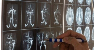 Mayo Clinic Minute: Lifesaving Treatments For Stroke (Video) https://www.vecteezy.com/photo/11245739-doctor-demonstarting-brain-mri-anatomy