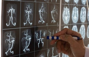 Mayo Clinic Minute: Lifesaving Treatments For Stroke (Video) https://www.vecteezy.com/photo/11245739-doctor-demonstarting-brain-mri-anatomy