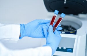 New RNA-Based Blood Test Shows Promise For Earlier Alzheimer’s Detection blood machine
