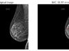 Mammograms May Help Identify Heart Disease Risk (VIDEO)