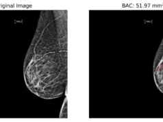 Mammograms May Help Identify Heart Disease Risk (VIDEO)