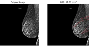 Mammograms May Help Identify Heart Disease Risk (VIDEO)