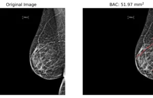 Mammograms May Help Identify Heart Disease Risk (VIDEO)