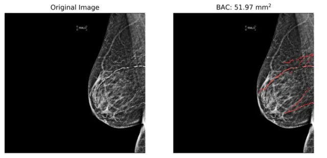 BAC-Mammogram