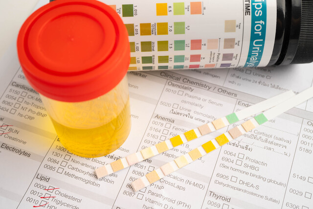 Urinalysis, urine cup with reagent strip pH paper test and compa https://www.vecteezy.com/photo/74463812-urinalysis-urine-cup-and-reagent-strip-ph-paper-test-and-comparison-chart-in-laboratory