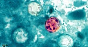 The Summer Salad Spoiler: Cyclospora Disease Spreads to Florida And 30 Additional States