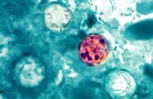 The Summer Salad Spoiler: Cyclospora Disease Spreads to Florida And 30 Additional States