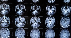 https://www.vecteezy.com/photo/19081031-mri-with-brain-tumor-magnetic-resonance-imaging