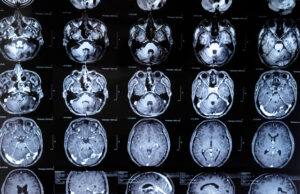 Treatment And Research Of Glioblastoma (Video) https://www.vecteezy.com/photo/19081031-mri-with-brain-tumor-magnetic-resonance-imaging