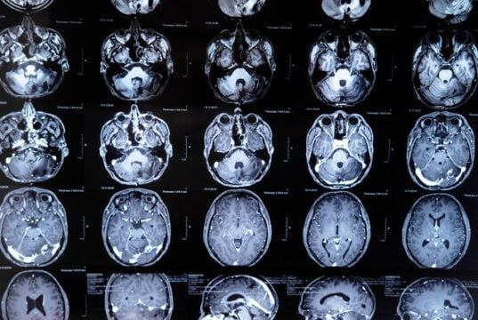 https://www.vecteezy.com/photo/19081031-mri-with-brain-tumor-magnetic-resonance-imaging
