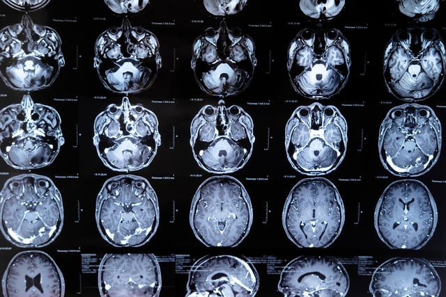 mri with brain tumor. Magnetic resonance imaging. https://www.vecteezy.com/photo/19081031-mri-with-brain-tumor-magnetic-resonance-imaging