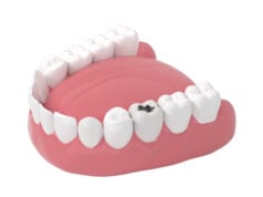 Pain-Free Liquid Fluoride Halts Tooth Decay Without Drills or Needles, Study Finds https://www.vecteezy.com/photo/27809486-tooth-decay-unhealthy-teeth-3d-rendering
