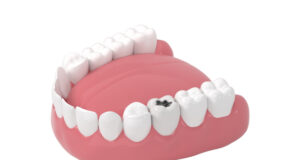 https://www.vecteezy.com/photo/27809486-tooth-decay-unhealthy-teeth-3d-rendering
