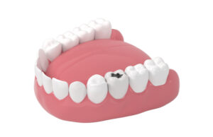 https://www.vecteezy.com/photo/27809486-tooth-decay-unhealthy-teeth-3d-rendering