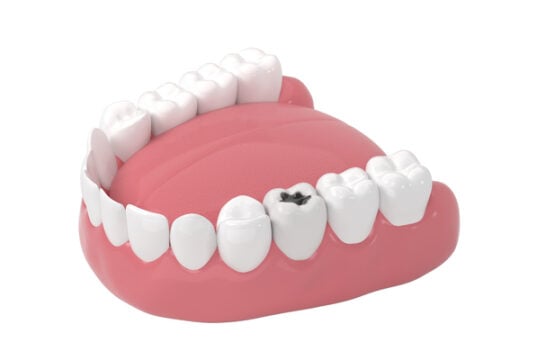 https://www.vecteezy.com/photo/27809486-tooth-decay-unhealthy-teeth-3d-rendering