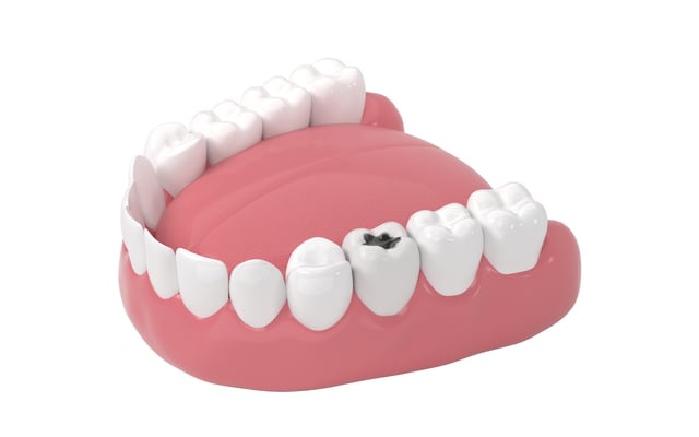 Tooth decay, unhealthy teeth, 3d rendering. https://www.vecteezy.com/photo/27809486-tooth-decay-unhealthy-teeth-3d-rendering