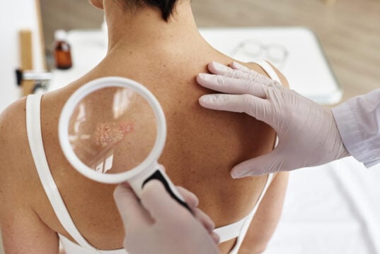 https://www.magnific.com/premium-photo/close-up-doctor-holding-magnifying-glass-examining-back-female-patient_88200960.htm#fromView=search&page=1&position=8&uuid=e26c3a7e-5568-4ed8-86f0-24a62b61842e&track=ais_hybrid&query=cancer+skin+lession